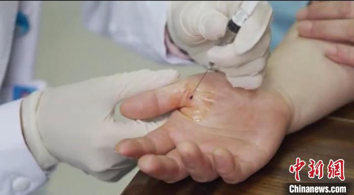 嘉善群眾體驗小針刀?！〖紊平y(tǒng)戰(zhàn) 供圖