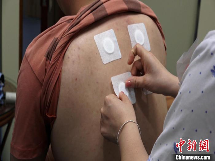 圖為醫(yī)生正在為民眾貼“三伏貼”?！√莆登?攝